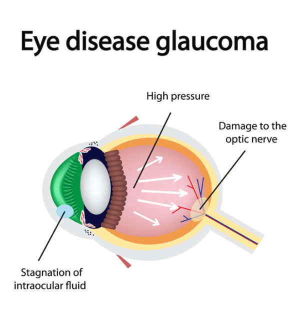 Cataracts