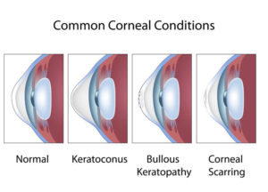 Contact Lenses Auckland