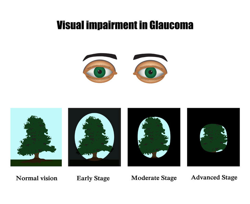 Glaucoma Symptoms