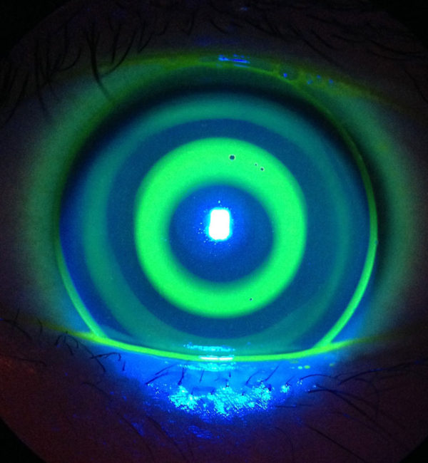 Keratoconus