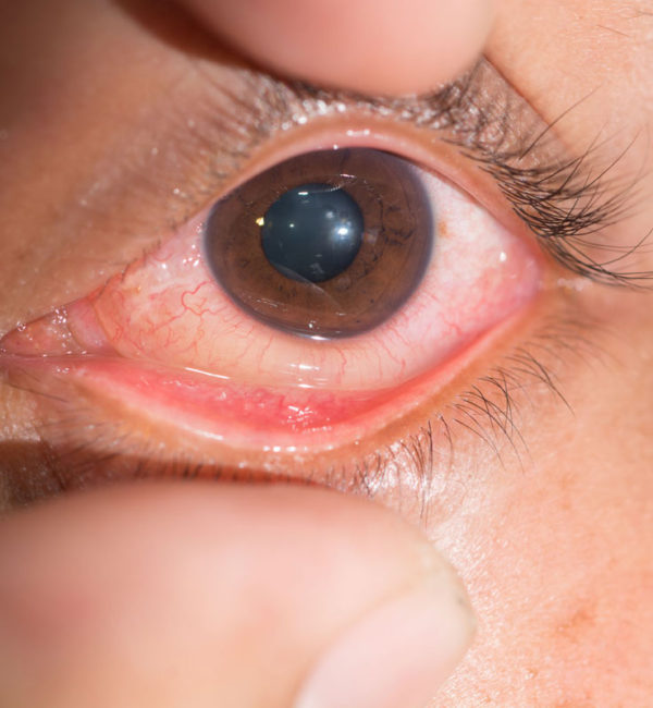 optometrist Optometrist