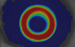 Orthokeratology
