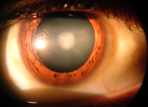 what is cataract