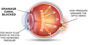 glaucoma-test-auckland