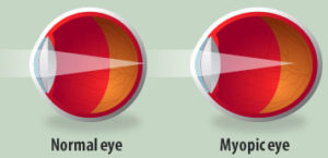 What Is Myopia? Shortsightedness That Can Cause Blindness. Save