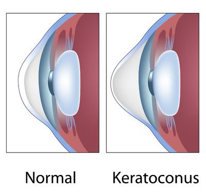 keratoconus help