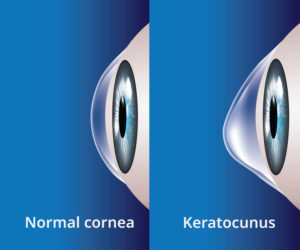 keratoconus diagnosis