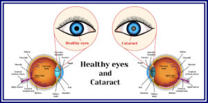 cataracts