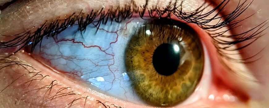 Managing Dry Eye | Dry Eye Syndrome or Keratoconjunctivitis Sicca | Homeopathic | Best Homeopathic Doctor in Pakistan | Dr Qaisar Ahmed MD, DHMS